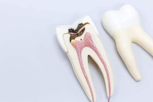 Ask a General Dentist: Is a Tooth Dead After a Root Canal from Hemet Dental Center: Brian Stiewel DDS, INC. in Hemet, CA