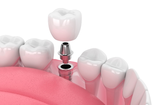 Basic Types Of Implants Offered By Implant Dentists