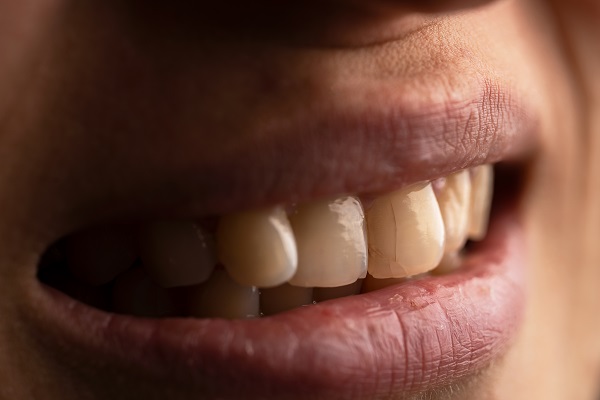 What Happens When A Cracked Tooth Goes Untreated?