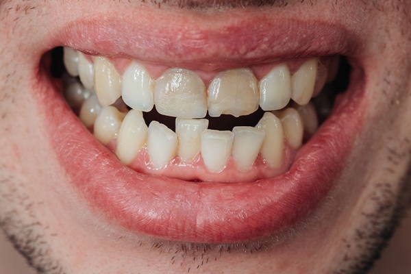 What To Do When You Experience A Broken Tooth