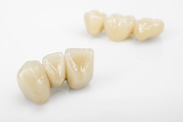 Improve Your Oral Health With A Dental Bridge