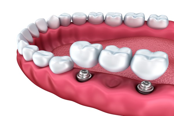 What A Dentist Can Tell You About The Dental Bridge Procedure