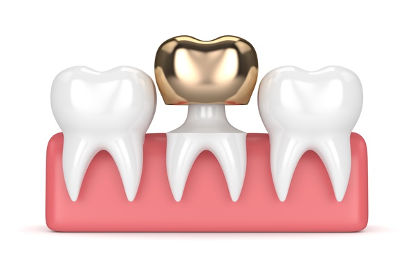 What To Do About A Loose Dental Crown