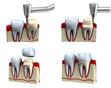 root canal metal crown