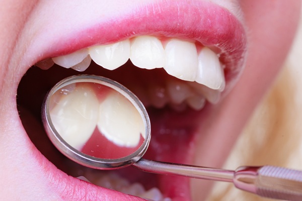 How To Know If Composite Fillings Are Right For You
