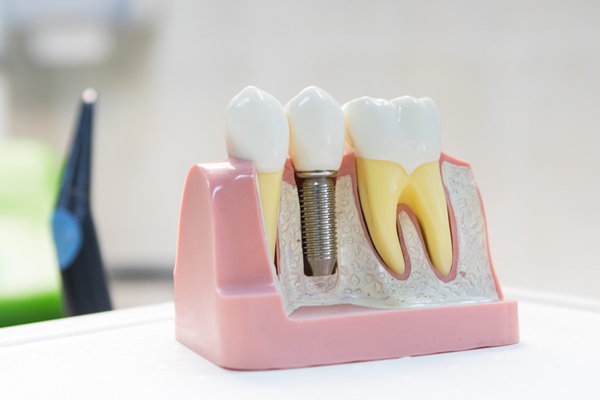 Proper Dental Implant Care In Your Oral Hygiene Routine