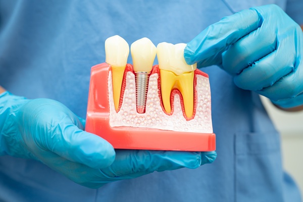 A Guide To Partial And Full Arch Dental Implants