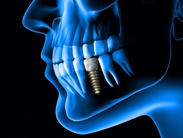 Oral Surgery FAQ: Dental Implants Placement