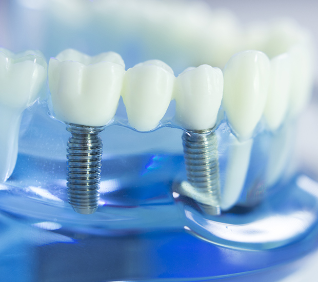 Hemet Dental Implants
