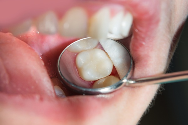 The Difference Between Dental Inlays And Dental Crowns