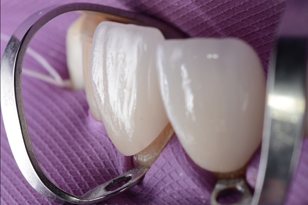 How Long Will A Dental Laminate Last?