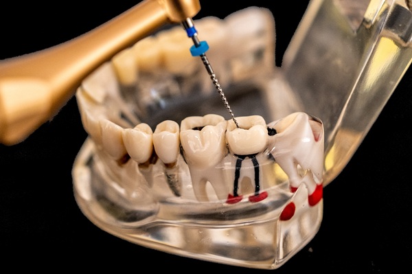 Signs That You May Benefit From Endodontic Treatment