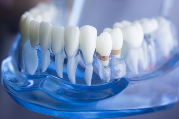 What You Should Know About Gum Disease