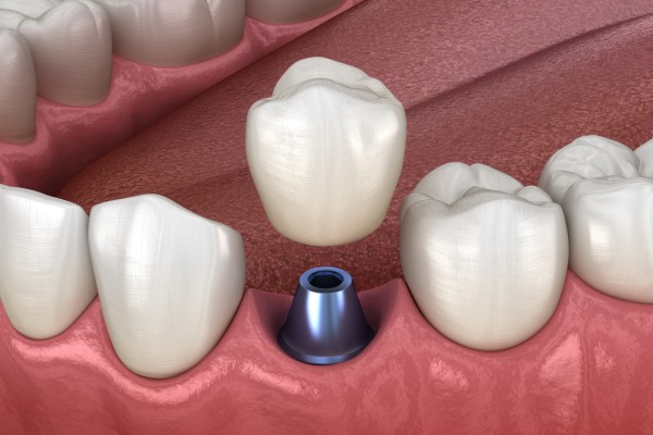 How Natural Will An Implant Crown Look?