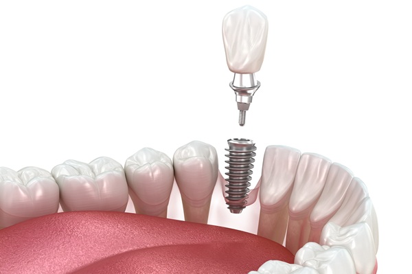 The Importance Of Implant Restoration