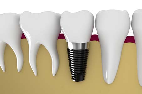 An Implant Restoration Treatment In Hemet Can Improve Your Smile And The Function Of Your Teeth