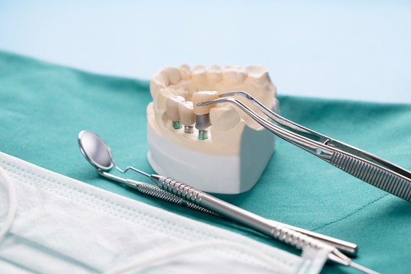 Differences Between Implant Supported Dentures And Traditional Dentures