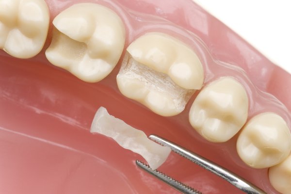 Tooth-Colored Fillings: Cavity Filling with Aesthetic Appeal