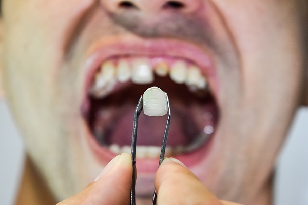 Common Options For Replacing Missing Teeth