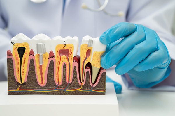 Debunking Root Canal Myths: How This Procedure Protects Oral Health