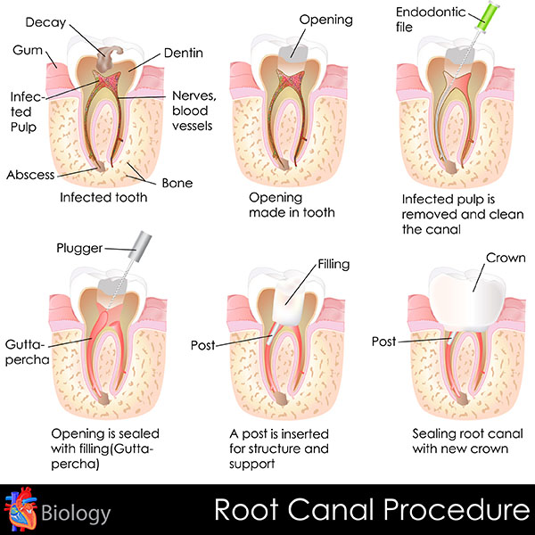 Root Canal Treatment Dental Dam, Safe Hygienic Teeth Restoration