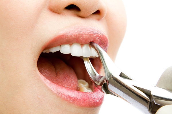 Tooth Extractions &#    ; What To Expect From The Process