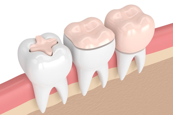 What Type of Materials Are Used in Dental Restorations? from Hemet Dental Center: Brian Stiewel DDS, INC. in Hemet, CA